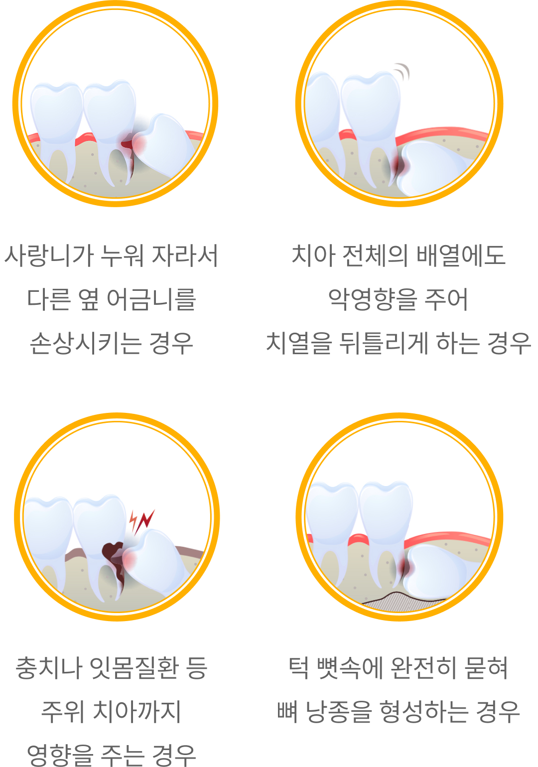 사랑니 발치 안내
