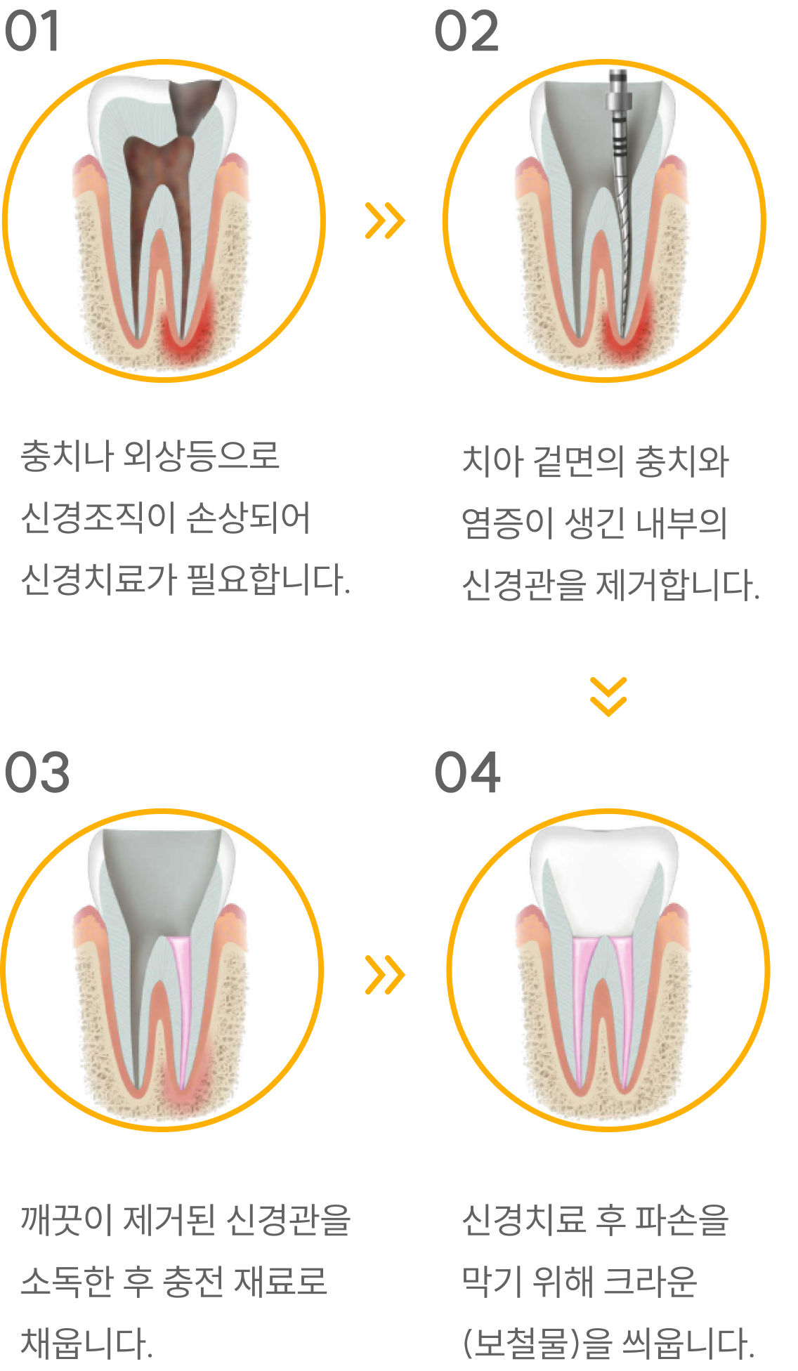 신경치료 과정