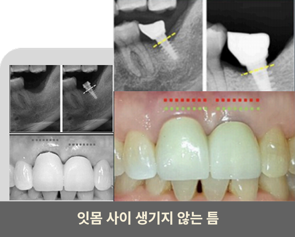 잇몸 사이 틈이 생기지 않는 임플란트 구조