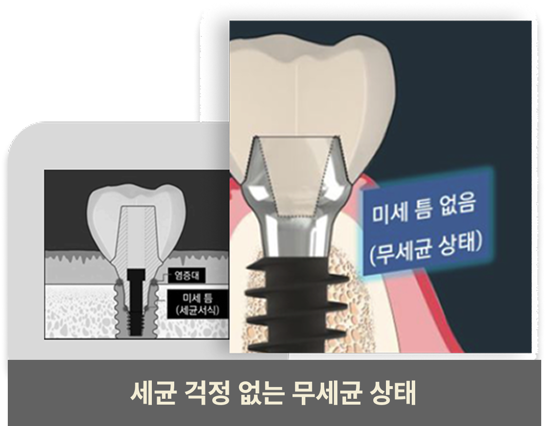 세균 걱정 없는 무세균 상태 임플란트